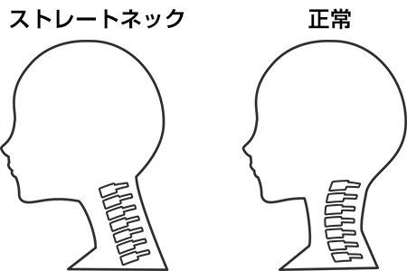 ストレートネックと正常な頸椎